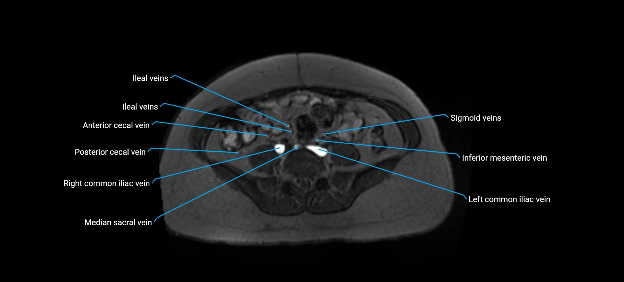 MRV abdomen pelvis & lower limb axial cross sectional anatomy labelled MRI image 125 (1).webp